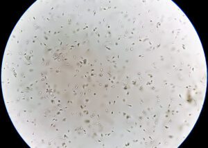 Sperm or semen analysis showing normal count with morphology.