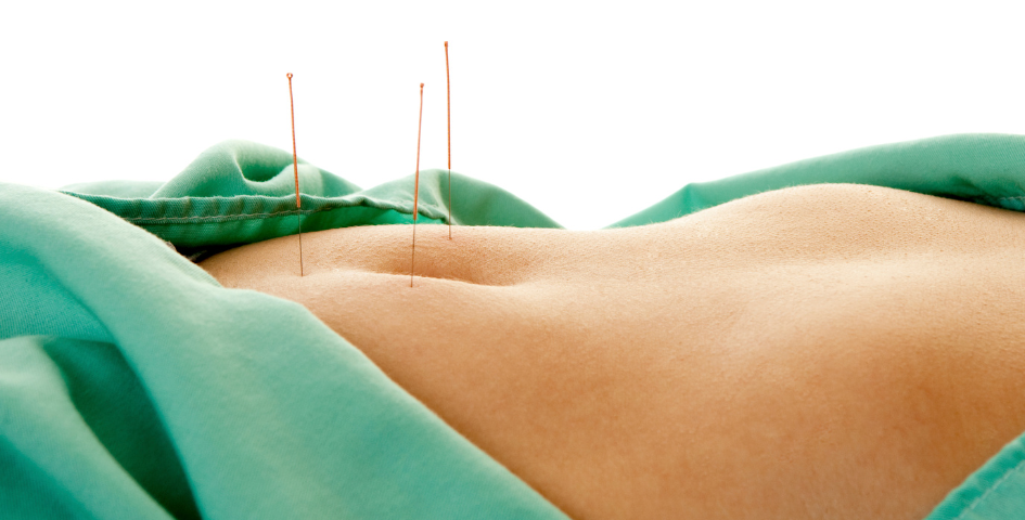 acupuncture