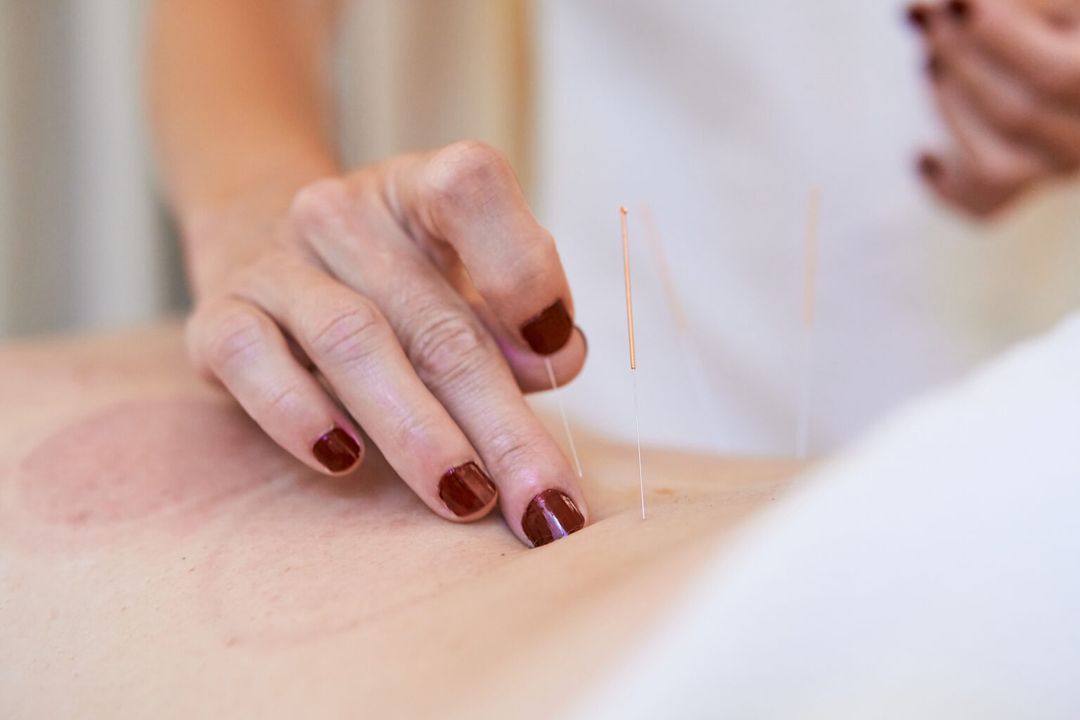 Close up of freelancer practitioner performing needle acupuncture therapy on lumbar back area to enhance fertility